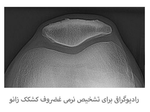 رادیوگرافی برای تشخیص نرمی غضروف کشکک زانو